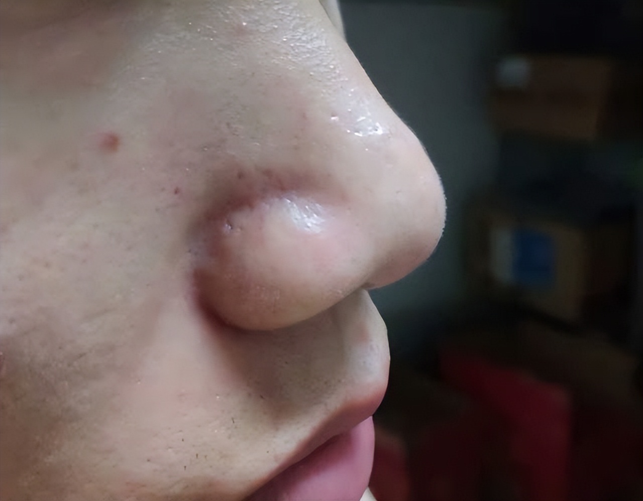 额头眉心发红有闭口粉刺,眉心鼻头频繁起粉刺怎么办