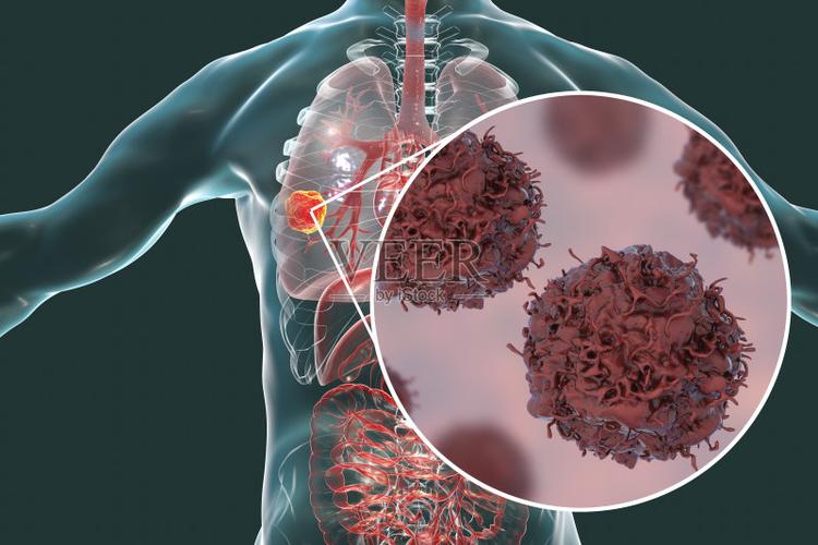 男子发现癌症早期,男子肺癌早期信号