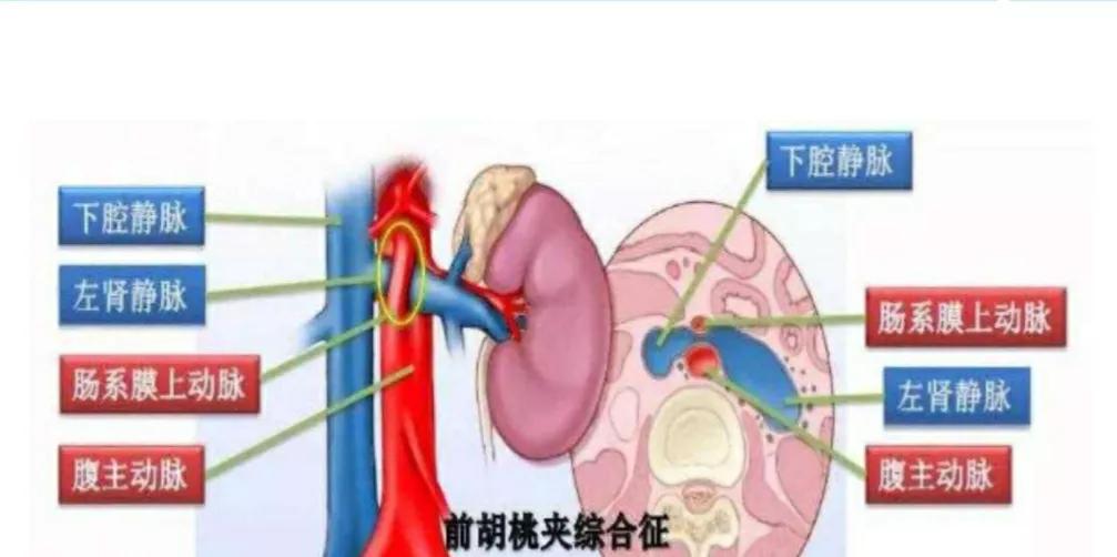 胡桃夹综合征持续尿血腰疼,女胡桃夹综合征会一直尿血吗