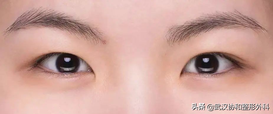 提眉术加开眼角,泡泡眼提眉术