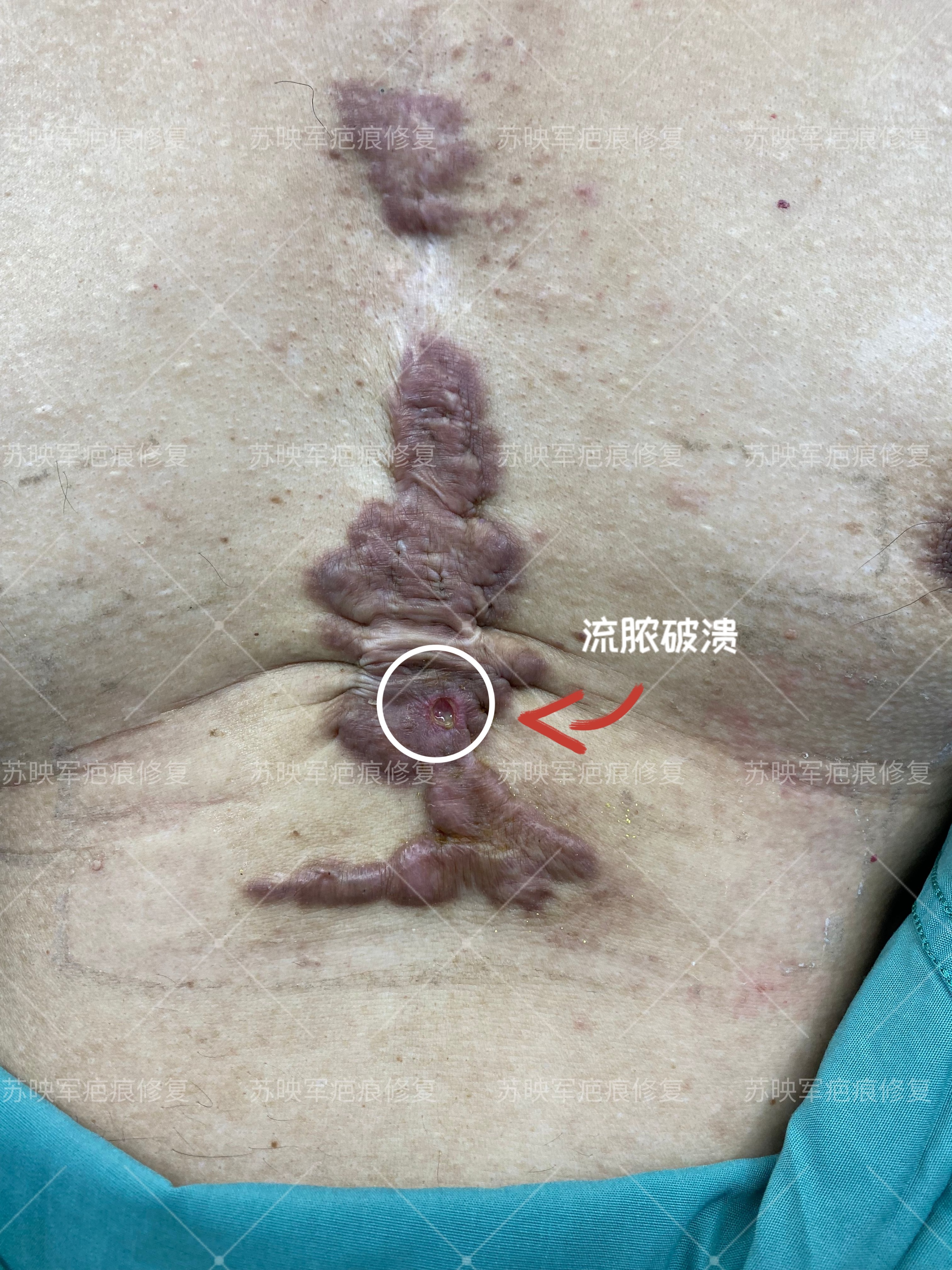 瘢痕疙瘩破溃流脓挂什么科,瘢痕疙瘩破溃怎么治疗