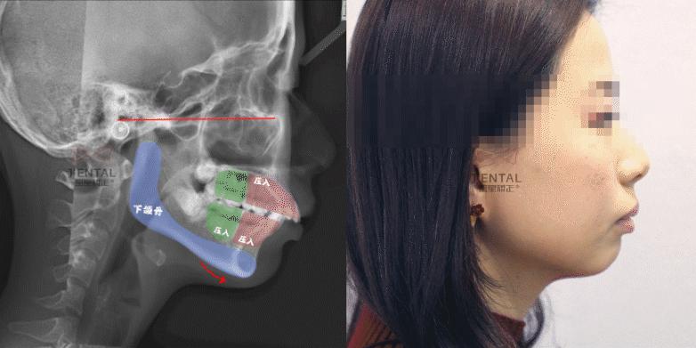 骨性龅牙怎么通过普通的矫正改善,骨钉如何解决骨性龅牙