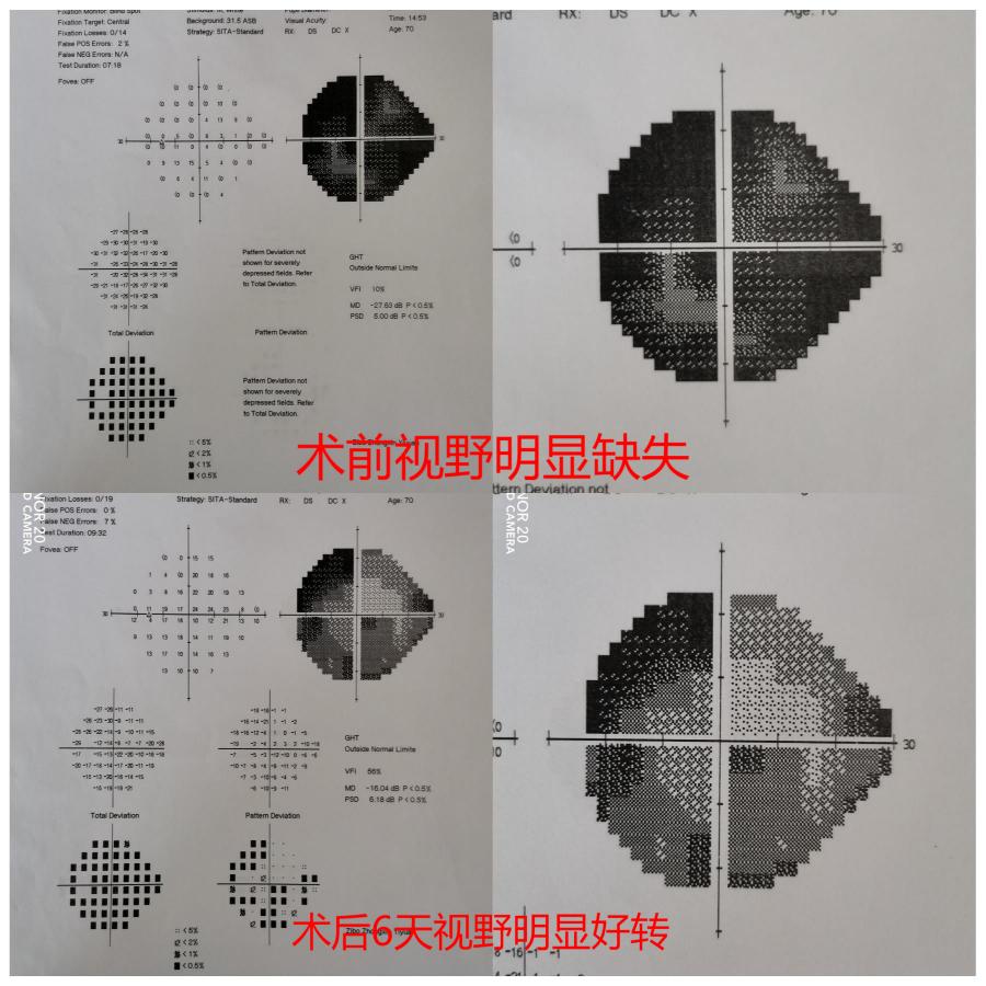 抢救失去的光明——市中心医院神经外科急症切除脑垂体瘤卒中一例