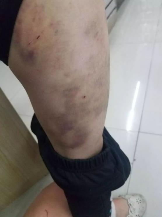 紫癜最忌口食物一览表,紫癜初期小血点图片