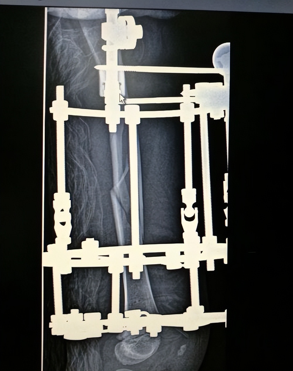 儿童股骨干粉碎性骨折对位不太好,儿童股骨干骨折石膏固定