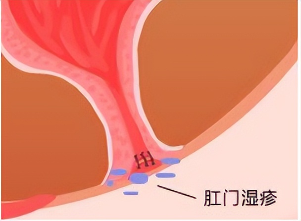 肛门潮湿且有分泌物怎么治疗,肛门潮湿与有分泌物怎么治疗
