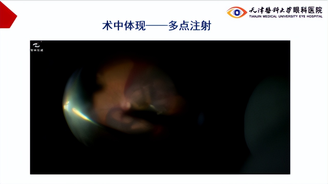 李筱荣教授,天津医科大学眼科医院李筱荣