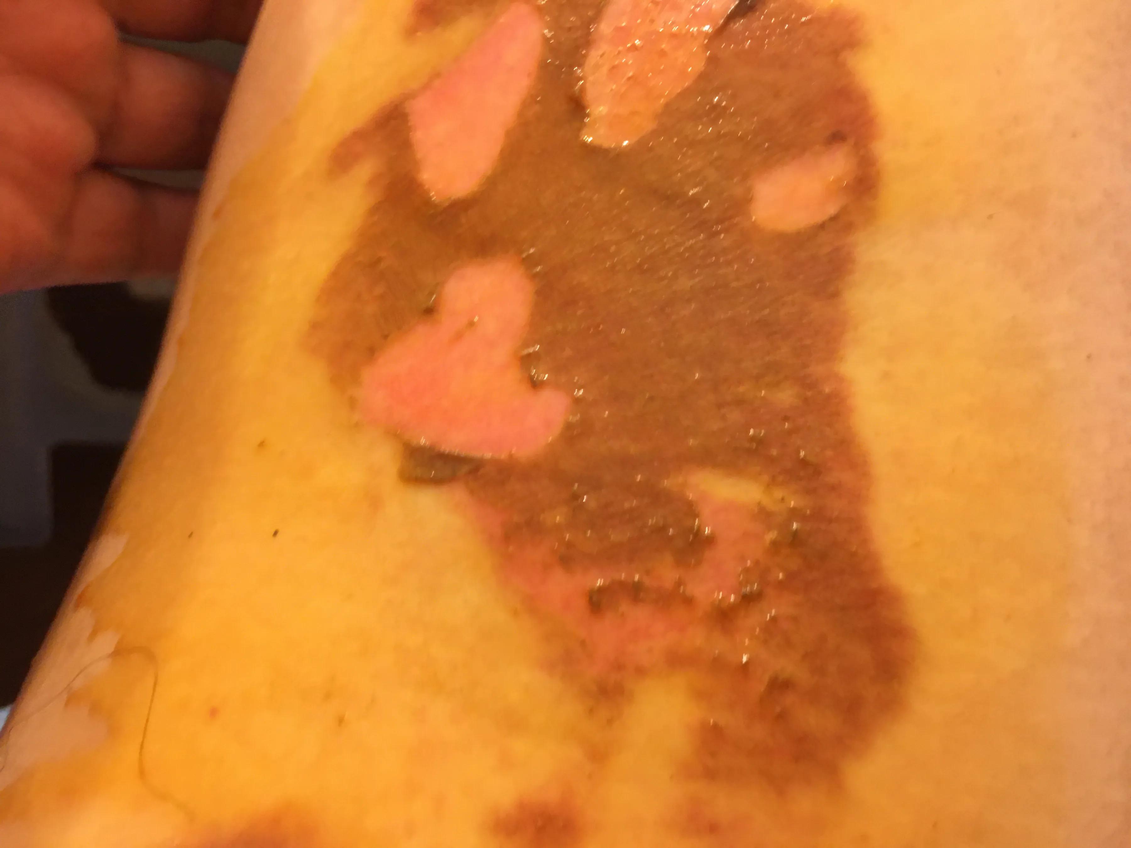 烫伤后续治疗费用怎么赔,烫伤的处理以及案例分析