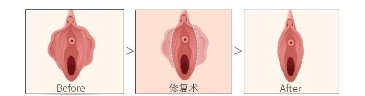 走路、骑车摩擦会痛……这个“难言之隐”该怎么解决？
