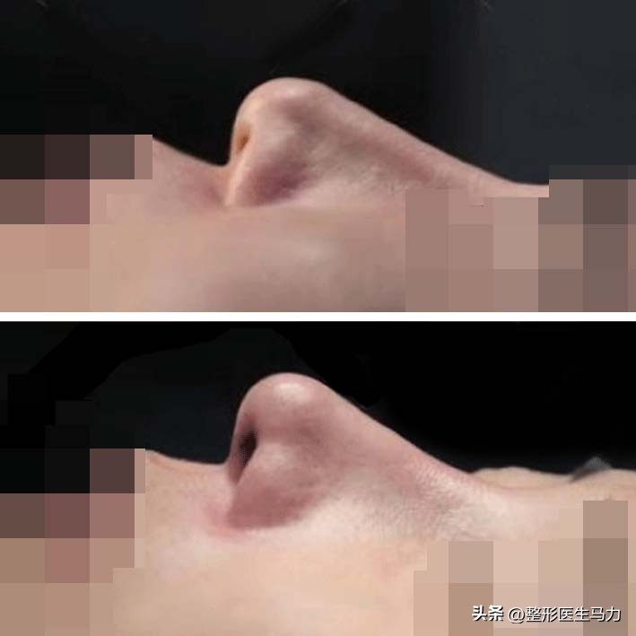 鼻基底玻尿酸栓塞后续治疗方法,鼻基底打玻尿酸栓塞后打溶解酶