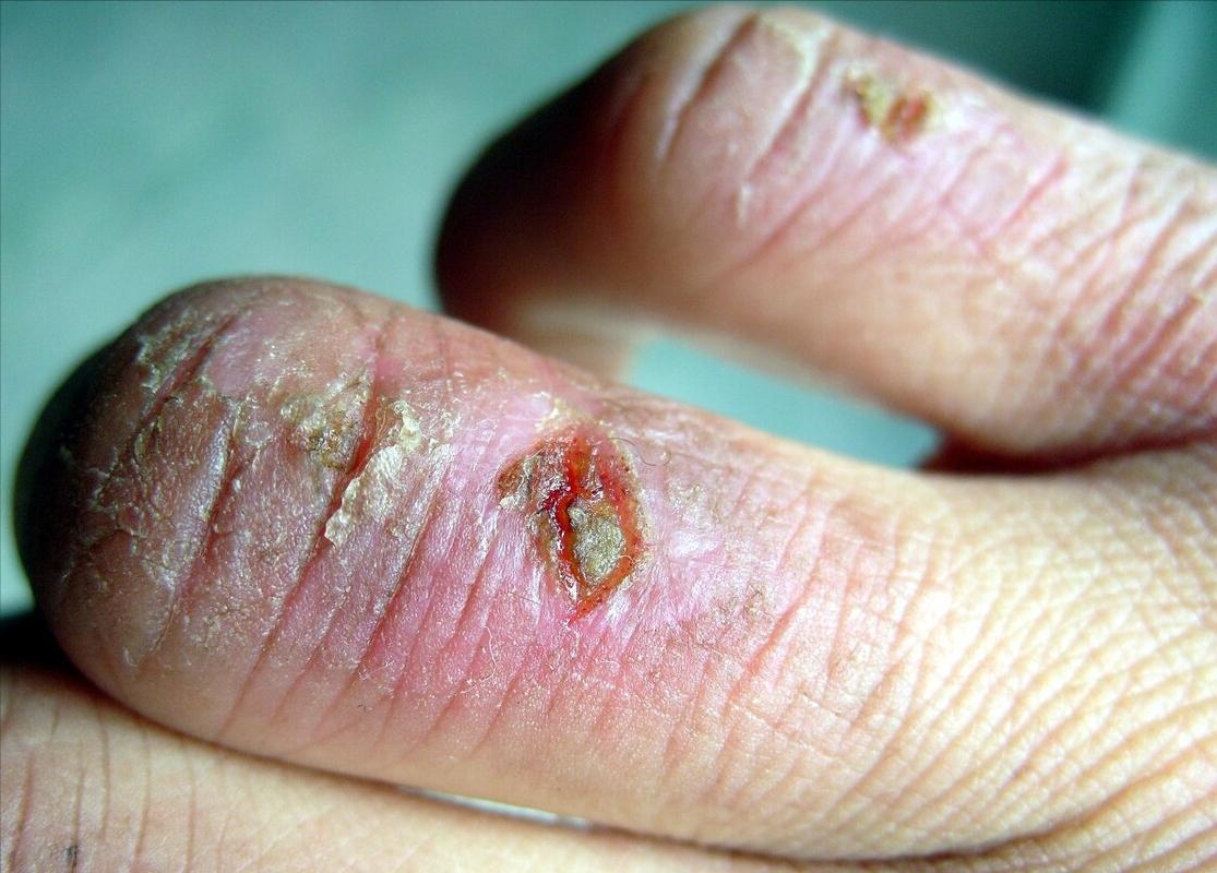 为什么冬天长冻疮的手会肿,为什么每年都长冻疮怎么解决