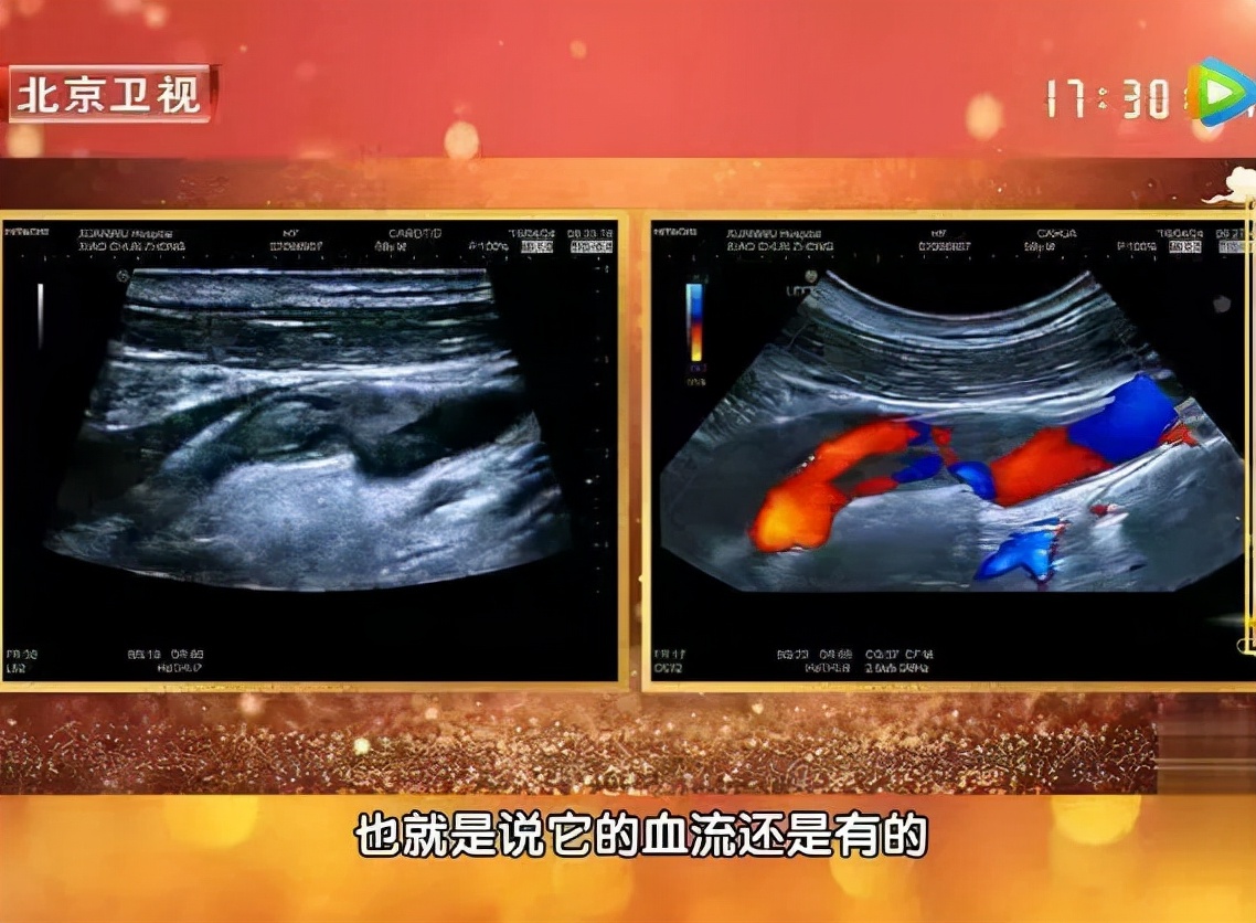 2年没复查结节竟然变成了癌症,息肉化验是癌前病变怎么办
