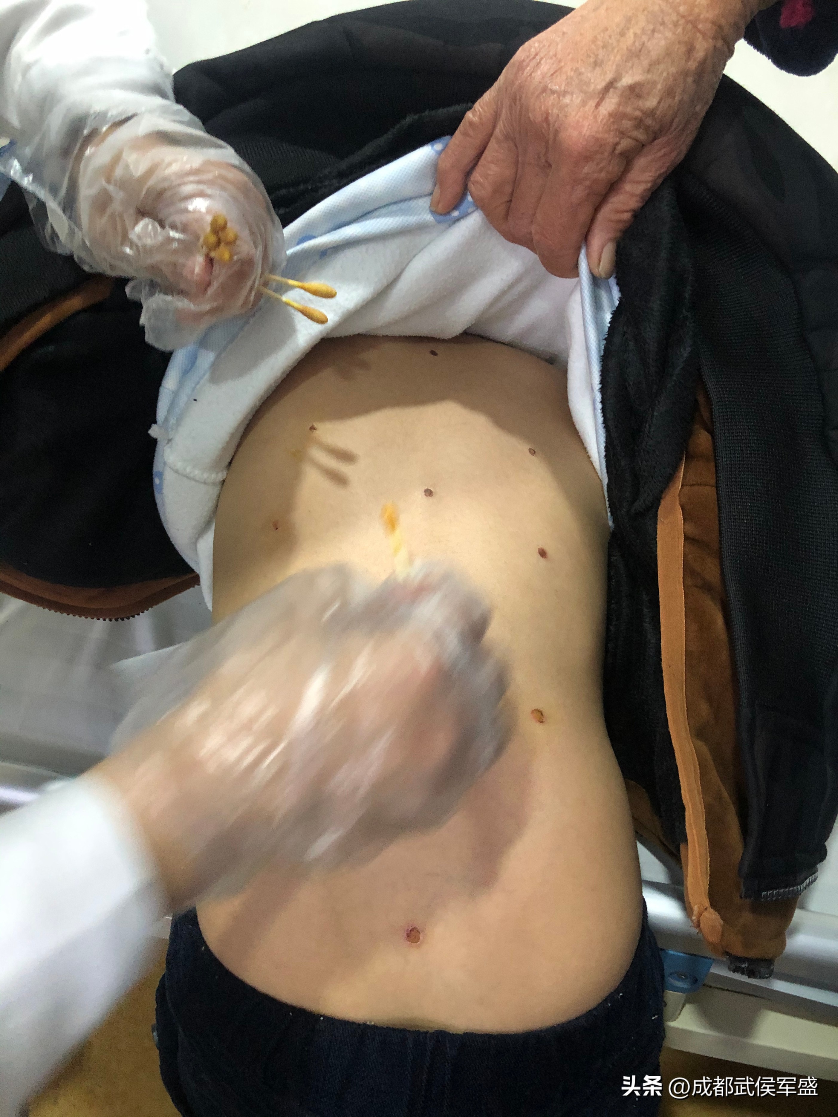 6岁男童被父亲烟头烫,癫痫发作被火烫伤的男孩