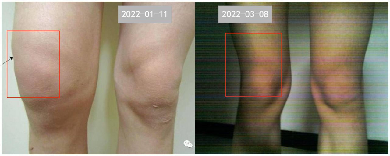 产后关节痛类风湿因子94,类风湿关节炎患者产后症状加重