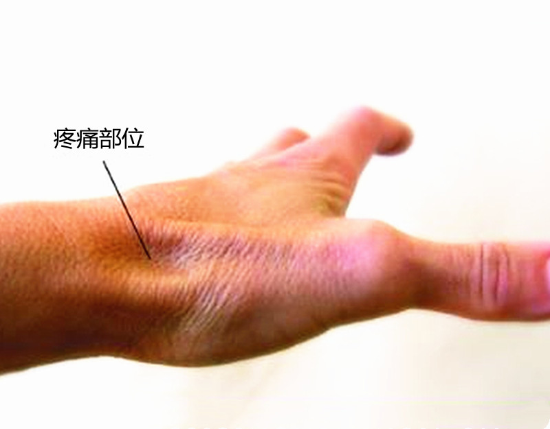 跌倒手腕很痛往下压,跌倒手掌撑地手腕受伤转动就痛