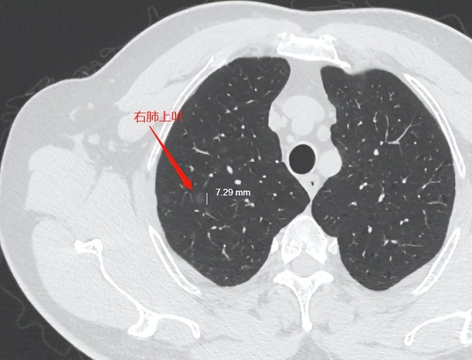 左肺乳头状鳞状细胞癌已手术，右肺的8mm肺结节现在怎么办？