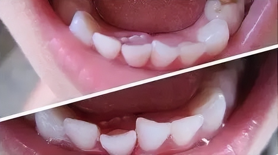 拔牙麻药对人体伤害有多大,牙齿整形需要拔牙伤害身体吗