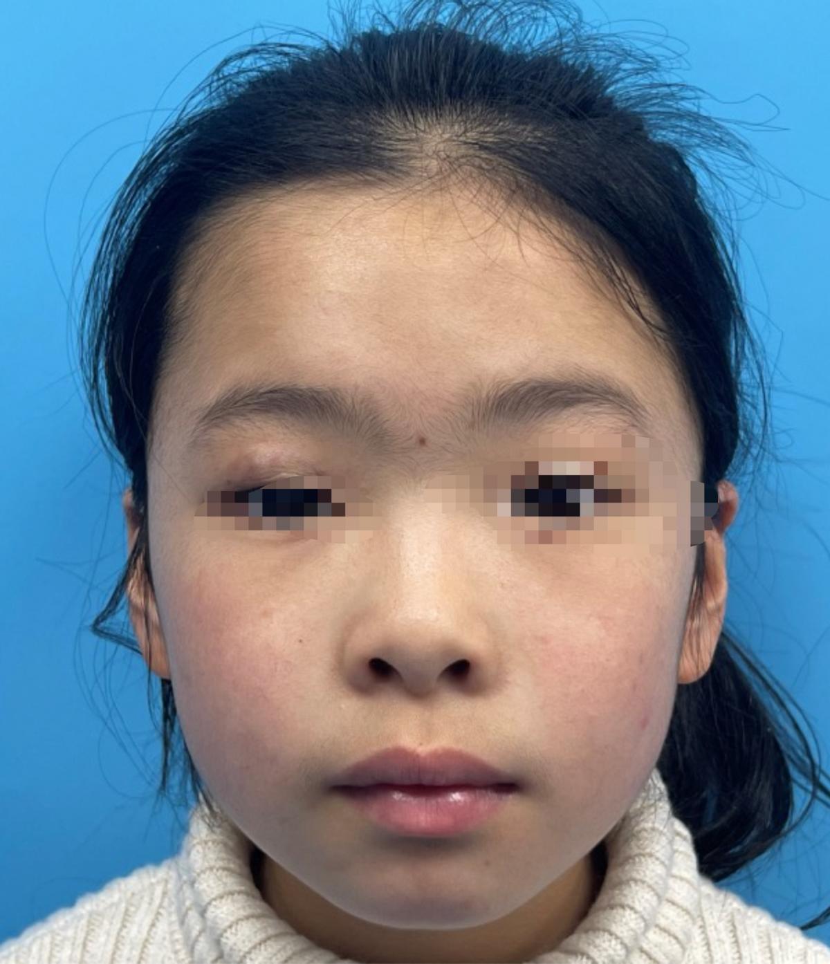 成人先天性眼睛长了血管瘤怎么办,新生儿血管瘤和先天性血管瘤