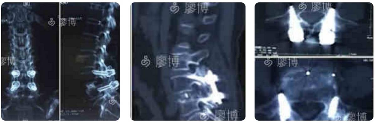 olif治疗腰椎滑脱有效吗,olif腰椎融合手术国内哪里做的好