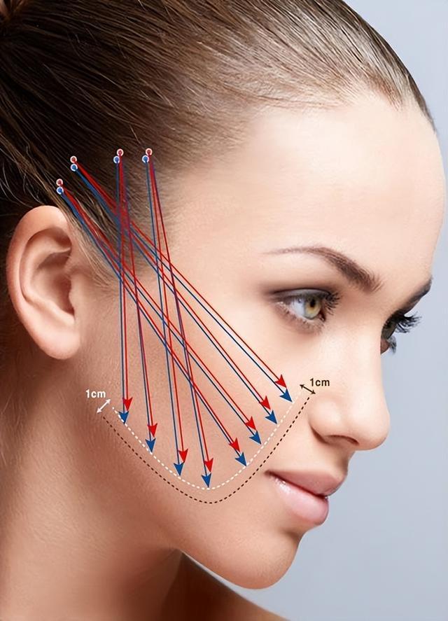 线雕的优势和副作用,线雕的适应症和禁忌症