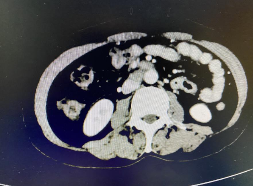 卵巢巨大肿瘤手术,卵巢肿瘤恶性手术方案