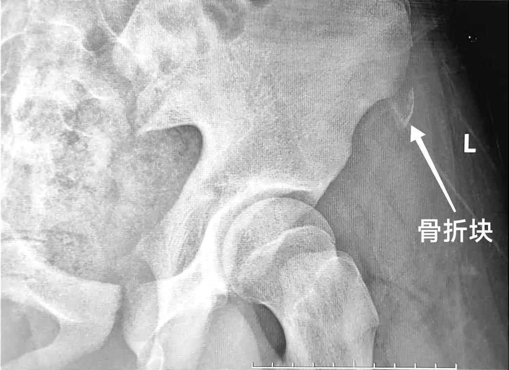 警惕｜跑完步后大腿根痛，一查竟是骨折了，青少年多见