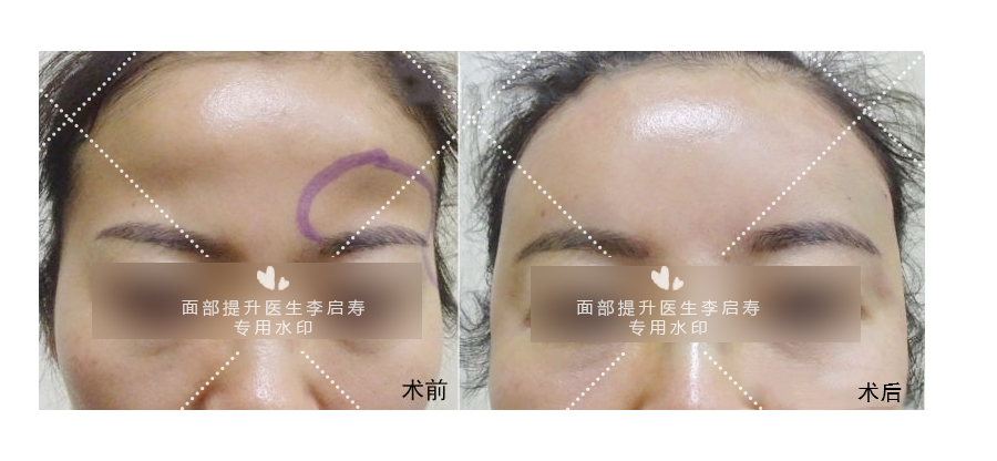 九院面部年轻化有哪些项目,40岁做什么医美项目可以提升脸部