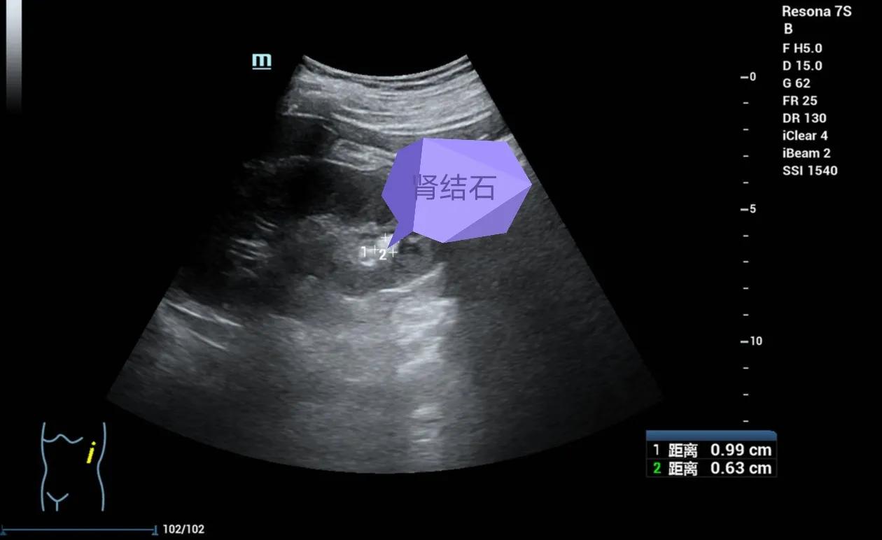 解读肾脏超声检查报告:肾结石、肾结晶、肾钙化灶到底什么关系?