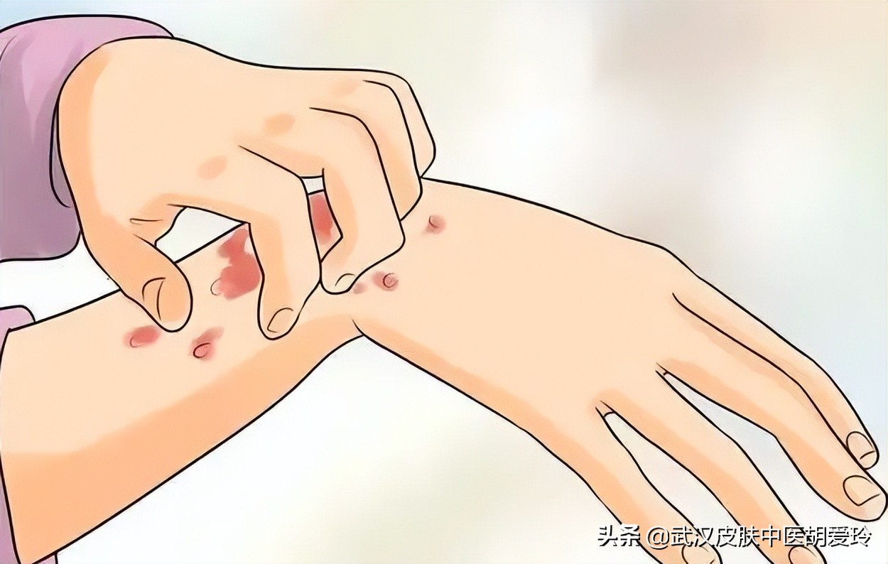 小腿部瘙痒越挠越痒用什么药,皮肤痒一挠就红一大片用什么药