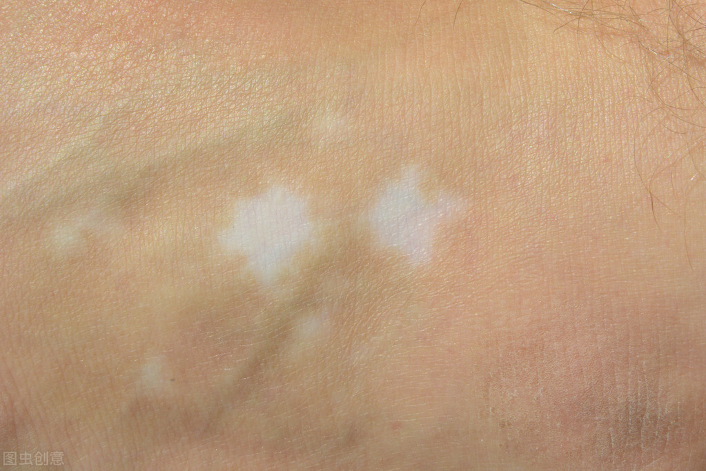 腰部有白癜风怎么治疗,腰部白癜风是什么原因