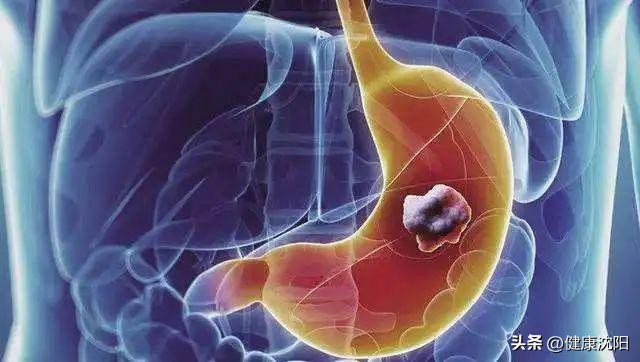 护胃健康从胃镜检查开始,国际护胃日浅表性胃炎