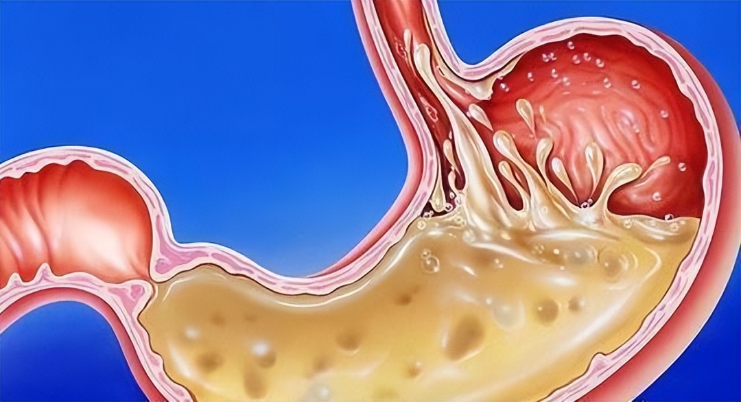 饭后总感觉反酸、烧心，应该怎么处理？3个建议或要听一听