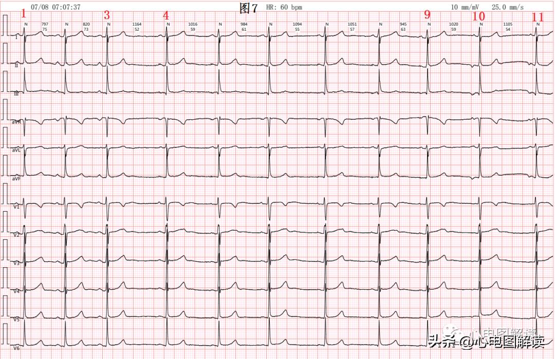 窦房结游走心律的临床意义,窦房结游走心律心电图特征