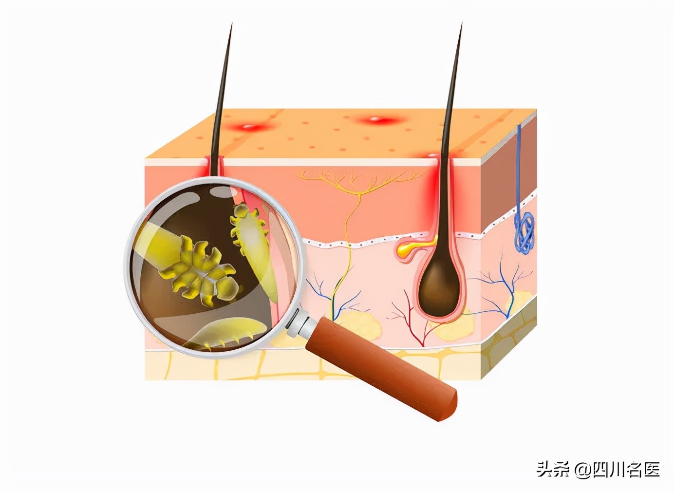 头屑越来越多是脱发的表现吗,头屑过多别忽视竟还暗藏脱发危机