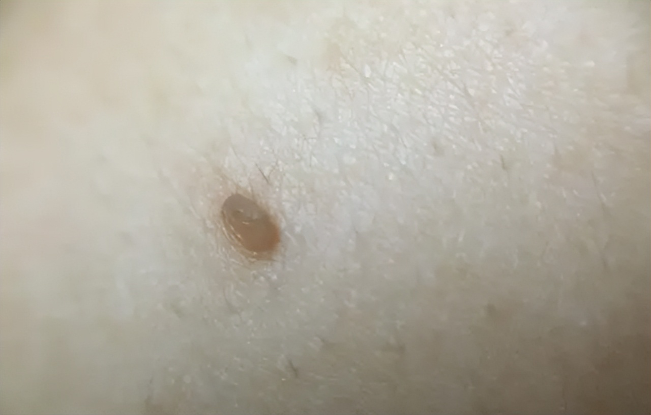 脖子上透明小肉粒可以揪下来,脖子上的小肉粒可以揪下来吗