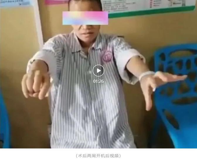 肌张力障碍植入脑起搏器有用吗,肌张力障碍脑起搏器手术费用