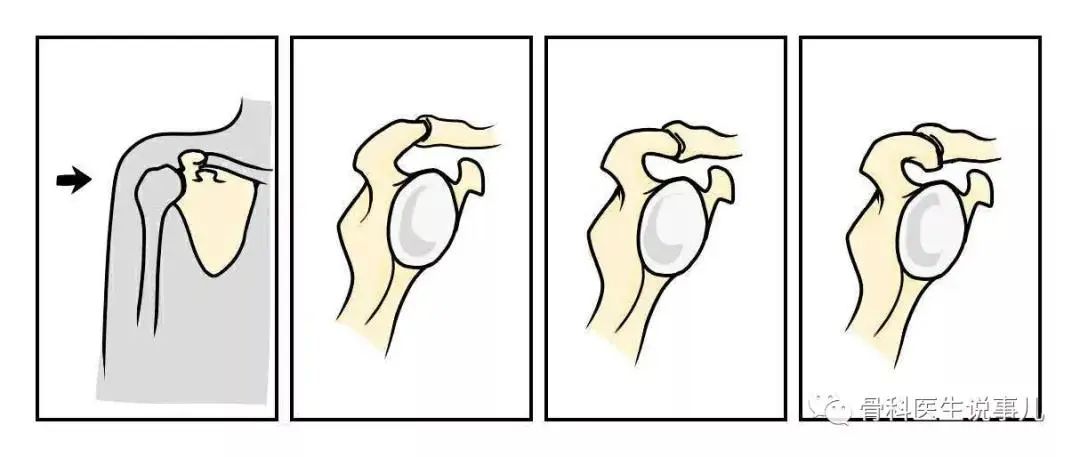 手臂抬举就酸胀是什么原因,手臂抬举肩膀就痛是什么原因