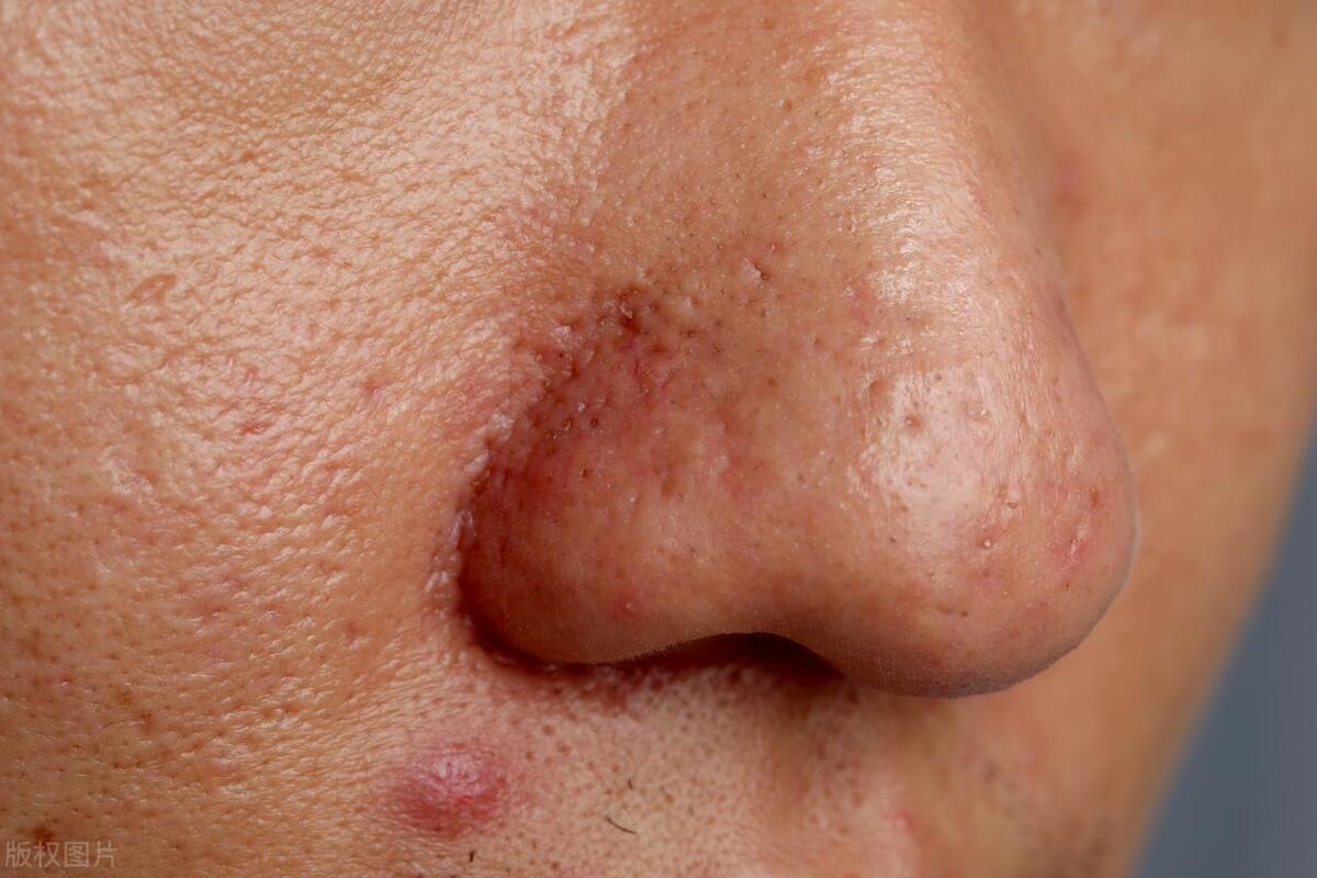 通窍活血汤治脑部淤血,血府逐瘀汤合通窍活血汤加减