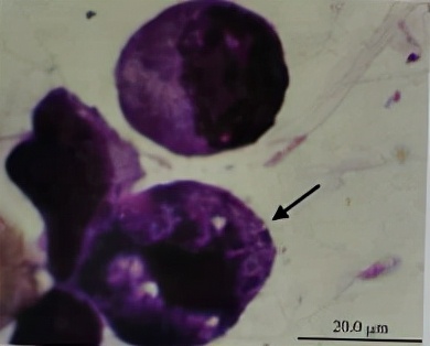 uu感染会自愈么,uu感染是hiv吗