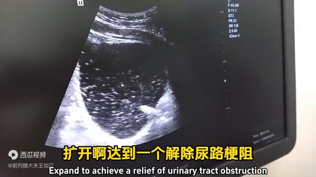 孔院长解读：什么是尿道疏通扩张术？配合前列腺钙化消融术...