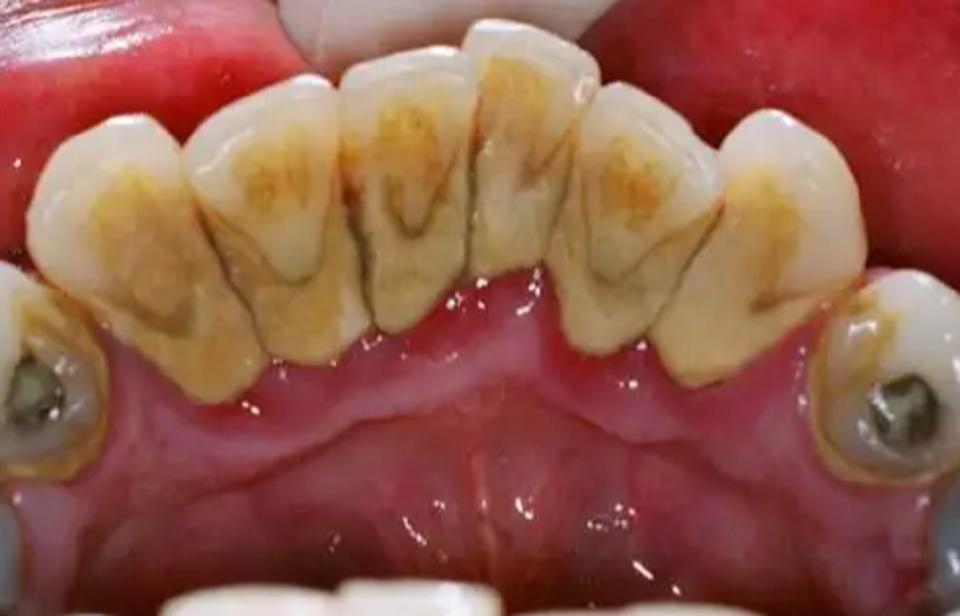 专治牙黄口臭的牙膏推荐测评,牙粉和牙膏刷牙去牙结石哪个好