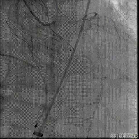病例回顾与分享,腹膜后血肿介入治疗
