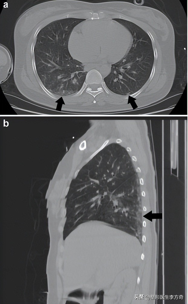 玻尿酸的填充有哪些危害,玻尿酸填充脸部凹陷危害