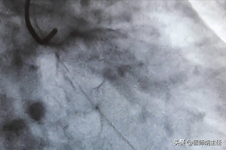 做冠状动脉造影对人体有副作用吗,做完冠脉造影后血管会变脆吗