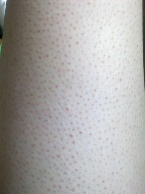 皮肤有鸡皮疙瘩,皮肤有鸡皮疙瘩是缺什么