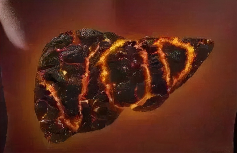 乙肝身上有蜘蛛痣是肝硬化吗,身上有蜘蛛痣是肝硬化晚期吗