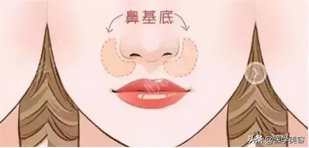鼻基底填充垫高鼻头,填充鼻基底会不会显得鼻头高