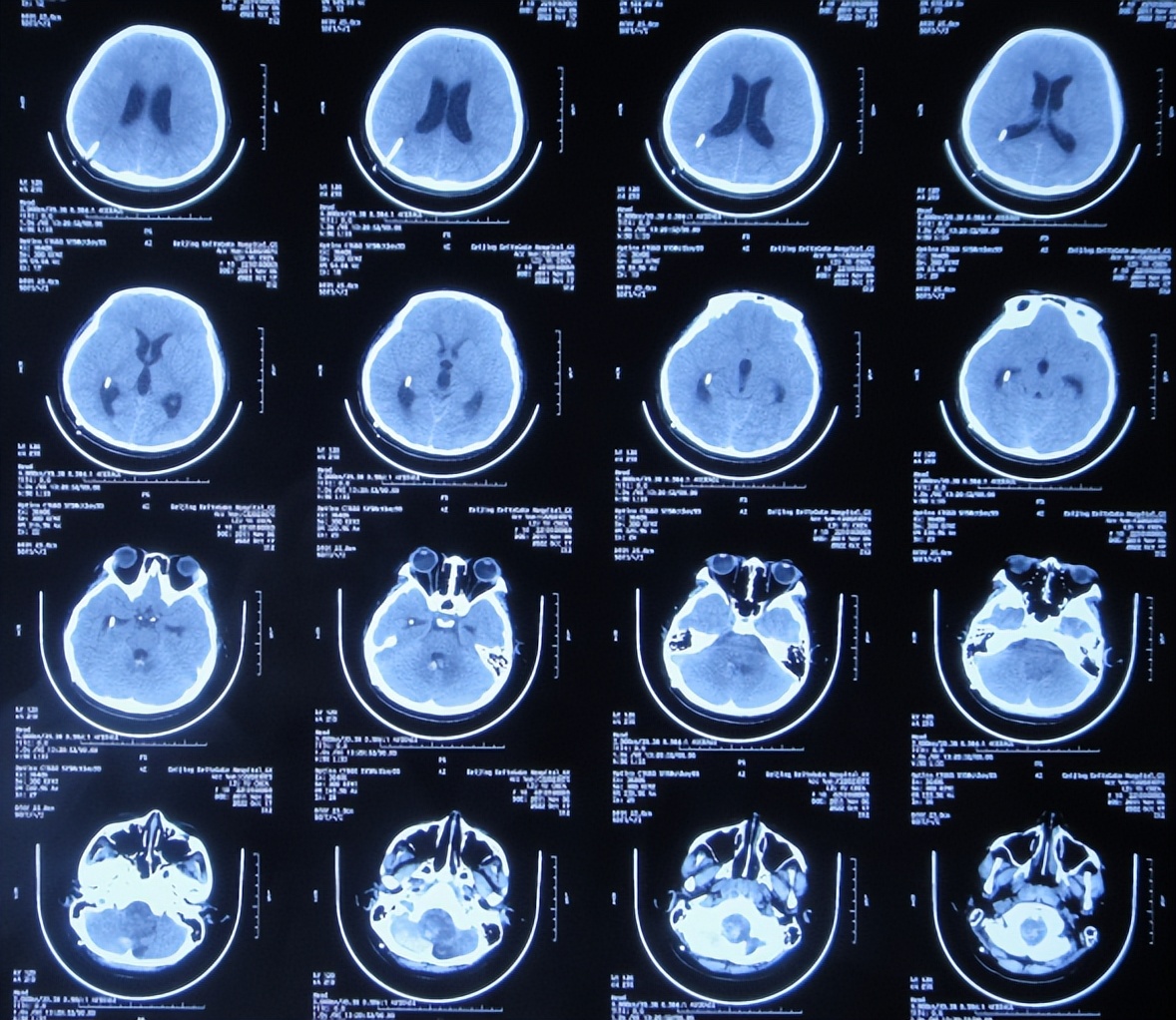 脑干出血儿童,儿童脑干胶质瘤呕吐