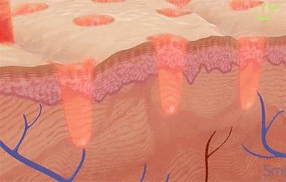 脸上到处是痘痘痘印痘坑怎么办,痘痘破了怎么处理不会留痘印痘坑