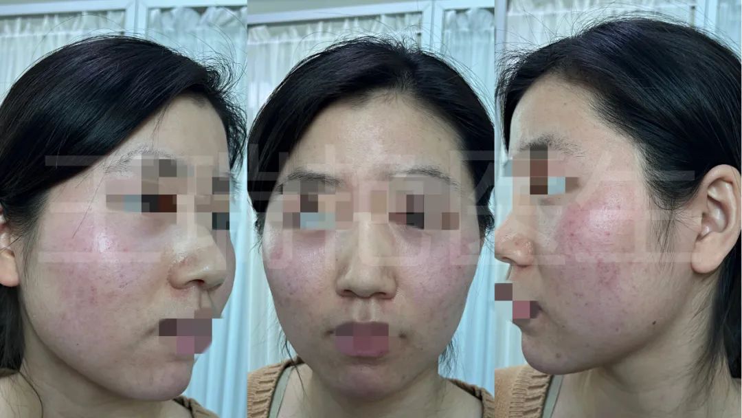 烂脸警告完整视频,烂脸警告